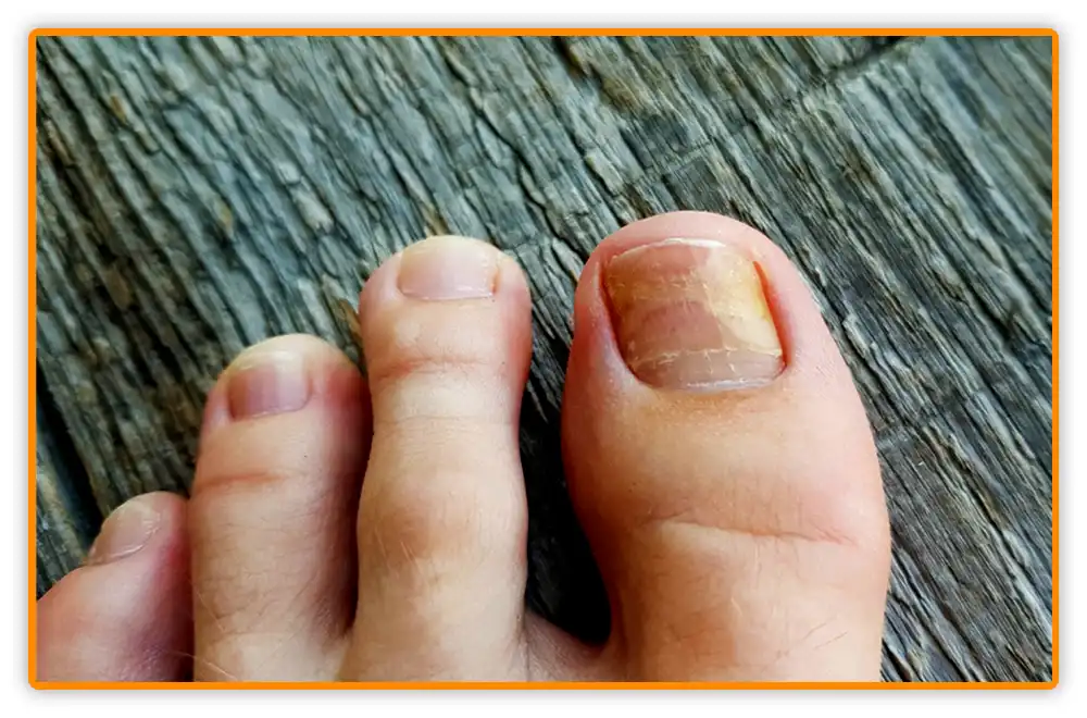 Early Signs: How to Know If Toenail Fungus is Dying