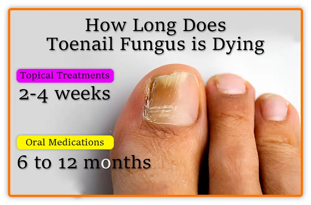 How Long Does Toenail Fungus is Dying