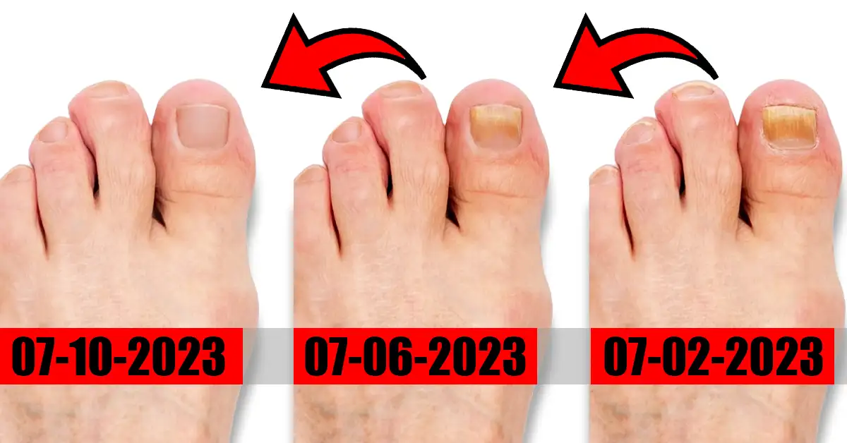 How to Know If Toenail Fungus is Dying