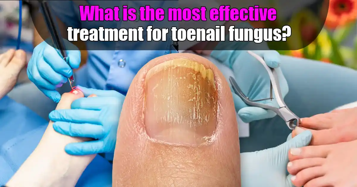 What is the Most Effective Treatment for Toenail Fungus?